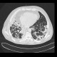 Lung tuberculosis, caseous pneumonia, HRCT: CT - Computed tomography